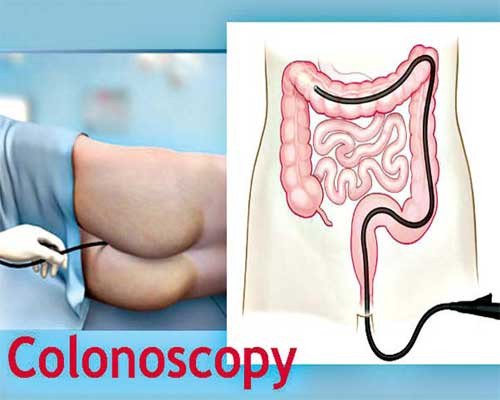 lower endoscopy procedure